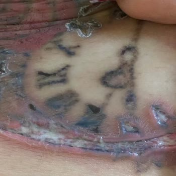 Dövme Silme İşleminde Ağır Yanıklar Ve Kalıcı İzler Oluştu, Sonuç Alınamadı