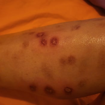 Yanlış Tedavi Sonrası Kalıcı İzler Ve Çözülmeyen Mağduriyet