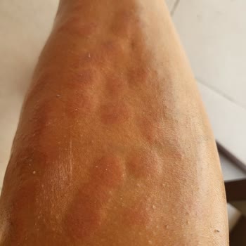 Yanlış Tedavi Sonrası Kalıcı İzler Ve Çözülmeyen Mağduriyet