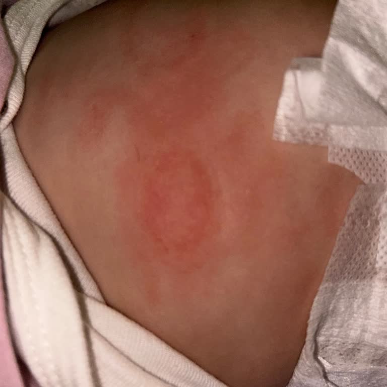 Mustela Şampuan Ve Yağ Bebeğimde Egzama Ve Tahrişe Sebep Oldu