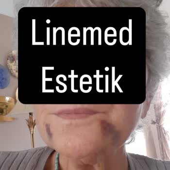 Gençlik Aşısı Sonrası Yüzümde Kalıcı Sorunlar Yaşadım