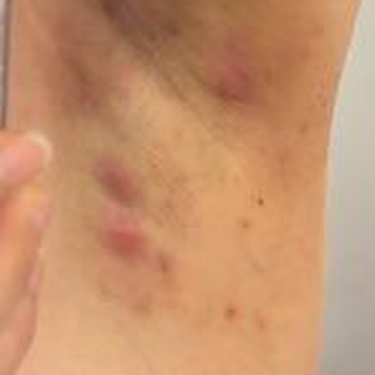 Rexona Roll On Kullanımı Sonrası Koltuk Altında Ağrılı Bezeler Oluştu