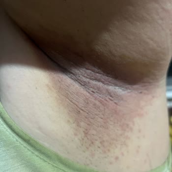 Rexona Deodorant Ciltte Ağrı, Yanma Ve Yaralara Sebep Oldu