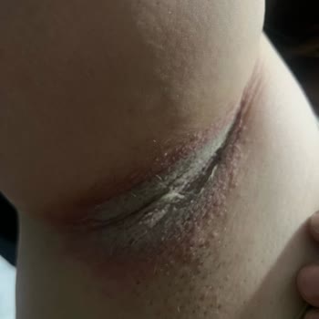 Rexona Deodorant Ciltte Ağrı, Yanma Ve Yaralara Sebep Oldu