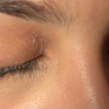 Bioderma Göz Kremi Cildi İyileştirmek Yerine Alerji Ve Kuruluk Yaptı