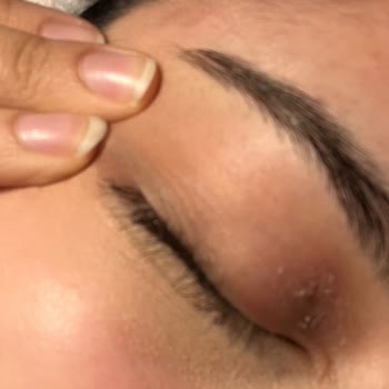 Bioderma Göz Kremi Cildi İyileştirmek Yerine Alerji Ve Kuruluk Yaptı