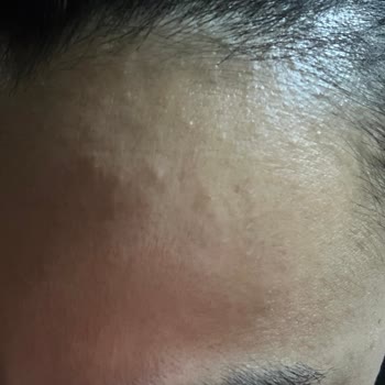 Nivea Yüz Yıkama Köpüğü Cildimde Sivilce Ve Yanmaya Sebep Oldu