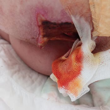 Kızımın Açık Yarası İçin Plastik Cerrahi Bölümünden Yetersiz İlgi