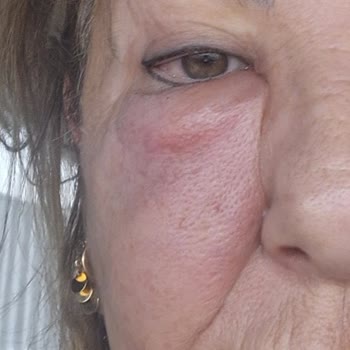 Yanlış Uygulama Sonrası Sağlık Sorunları Ve İlgisiz Davranış