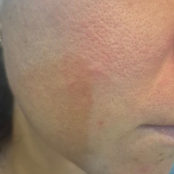 Neutrogena Yıkama Jeli Cildimde Ciddi Reaksiyona Sebep Oldu