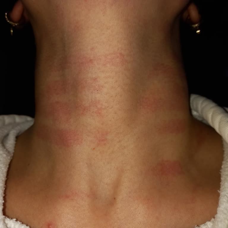 Nezz Estetik Ve Güzellik Merkezi Hijyene Dikkat Etmiyorlar ve Vücudumu Yaktılar