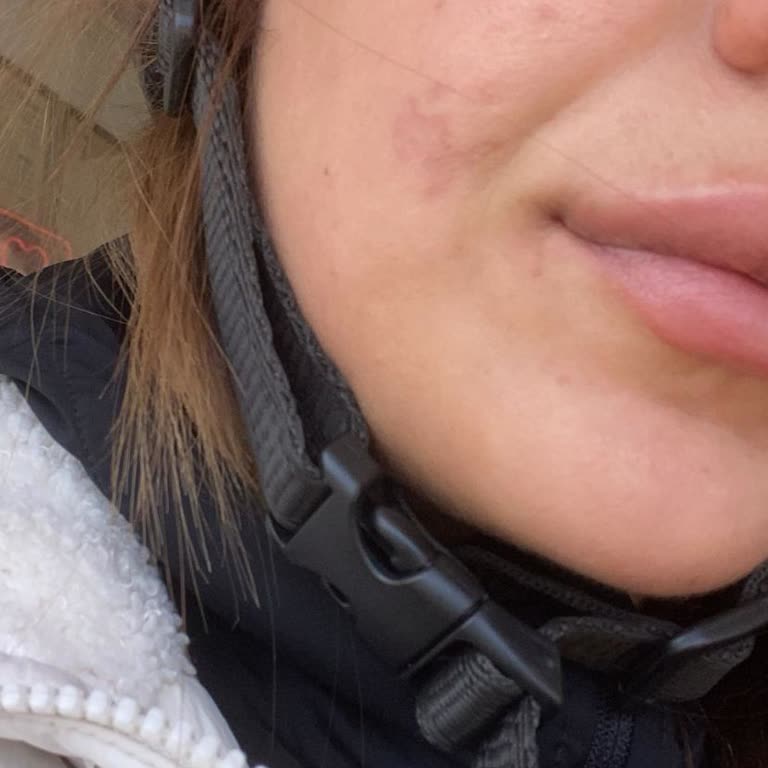 İşlem Sonrası Yüzümde Kızarıklık Ve İlgisiz Personel Deneyimi