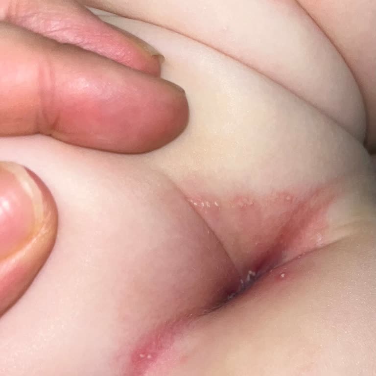 Mustela Pişik Kremi Sonrası Bebeğimde Sivilce Ve Kızarıklık Oluştu