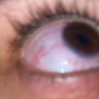 Aldığım Lensler Göz Sağlığımı Tehlikeye Attı, Acil Destek Bekliyorum