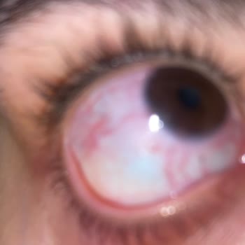 Aldığım Lensler Göz Sağlığımı Tehlikeye Attı, Acil Destek Bekliyorum