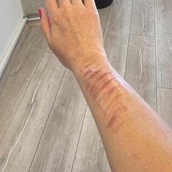 Lazer Epilasyon Denemesi Sonrası Ciddi Yanık Ve İlgisiz Yaklaşım