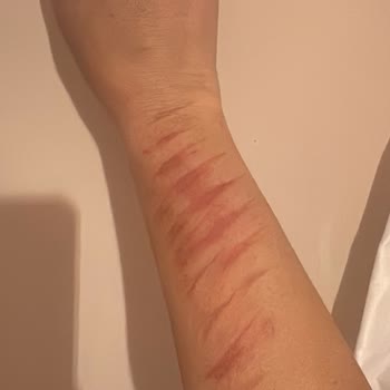 Lazer Epilasyon Denemesi Sonrası Ciddi Yanık Ve İlgisiz Yaklaşım