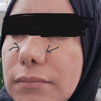 Dr. Abdurrahman Bozkurttan Sözlerinde Durmadılar, Burnum Mahvoldu