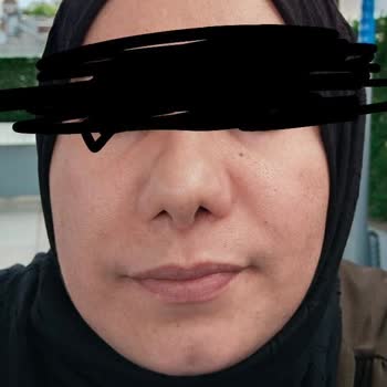 Dr. Abdurrahman Bozkurttan Sözlerinde Durmadılar, Burnum Mahvoldu