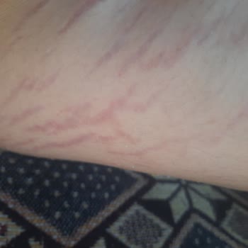 Herbalife Gesundheitsschäden durch unerwähnte Nebenwirkungen des Produkts