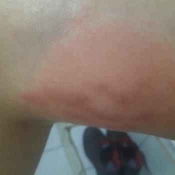 Herbalife Gesundheitsschäden durch unerwähnte Nebenwirkungen des Produkts