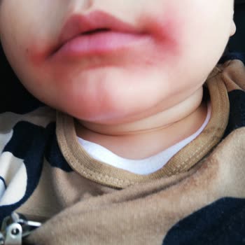 Philips Avent Emzik Dudaklarda Kızarıklık Ve Boya Sorunu Yaşattı