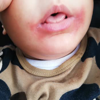 Philips Avent Emzik Dudaklarda Kızarıklık Ve Boya Sorunu Yaşattı