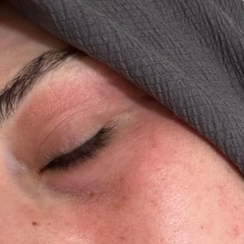 Loreal Bright Reveal Güneş Kremi Yüzümde Yanma Ve Acıya Sebep Oldu