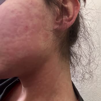 Antibiyotik Kullanımı Sonrası Hayati Sağlık Sorunları Yaşadım