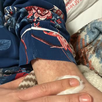 Antibiyotik Kullanımı Sonrası Hayati Sağlık Sorunları Yaşadım