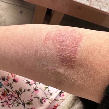 Antibiyotik Kullanımı Sonrası Hayati Sağlık Sorunları Yaşadım