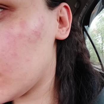 La Roche Posay Seti Sonrası Ciltte Tahriş Ve Kızarıklık