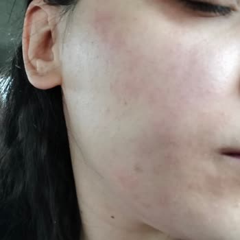 La Roche Posay Seti Sonrası Ciltte Tahriş Ve Kızarıklık