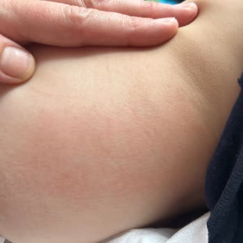 Molfix Bebek Bezi Alerji Ve Pişik Yaptı, Mağduriyetimin Giderilmesini İstiyorum