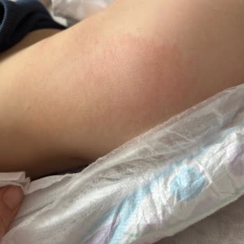 Molfix Bebek Bezi Alerji Ve Pişik Yaptı, Mağduriyetimin Giderilmesini İstiyorum