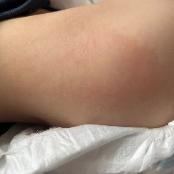 Molfix Bebek Bezi Alerji Ve Pişik Yaptı, Mağduriyetimin Giderilmesini İstiyorum