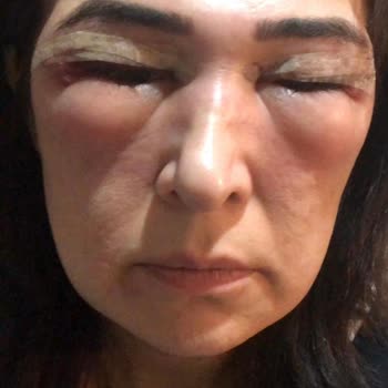 Göz Kapağı Ameliyatı Sonrası Beklenmedik Sorunlar Ve İlgisizlik