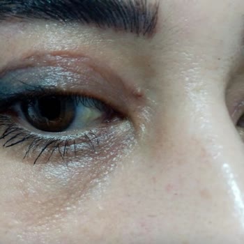 Göz Kapağı Ameliyatı Sonrası Beklenmedik Sorunlar Ve İlgisizlik