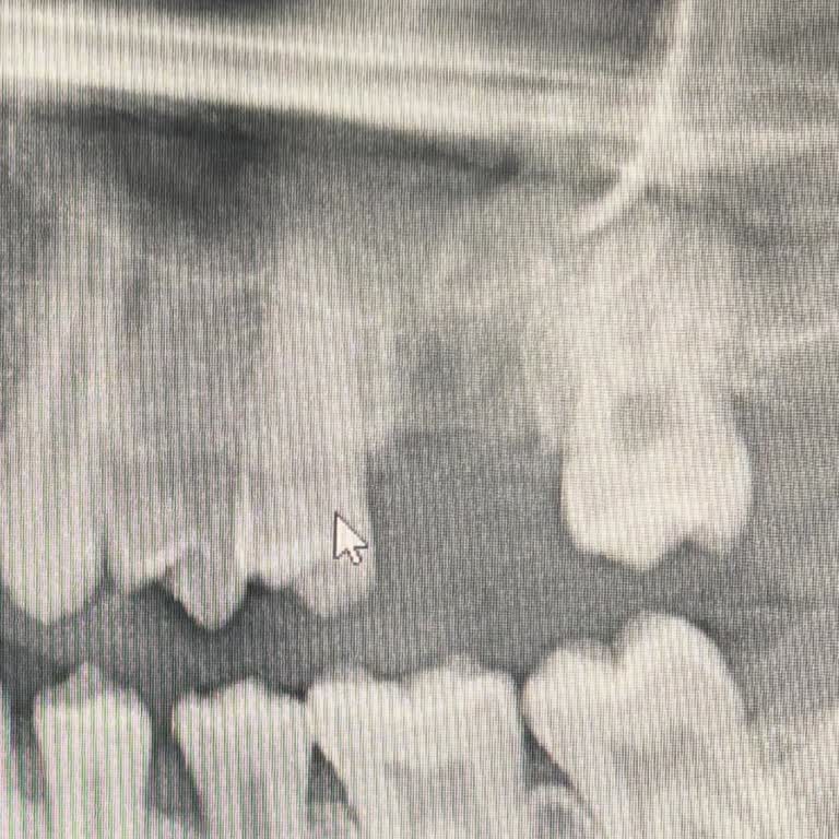 Kanal Tedavisi Sonrası Oğlumun Dişi Enfekte Oldu, Diş Kaybı Yaşadık