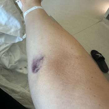 Hastanede Travmatik Ameliyat Ve İletişim Sorunları