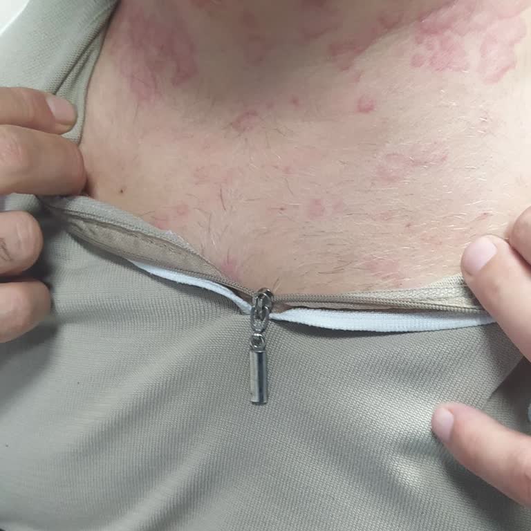 Alerji Tahlili Yapılmadı, Hemşireler Kan Alırken Zorlandı