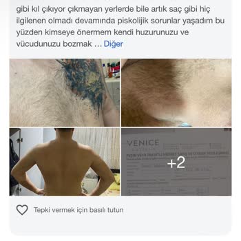 Epilasyon Sonrası Kıl Artışı Ve İlgisizlik Nedeniyle Mağduriyet