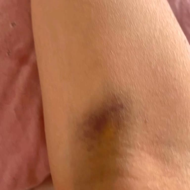 Kardiyoloji Bölümünde Damarım Patlatıldı, Ağrım Dinmiyor