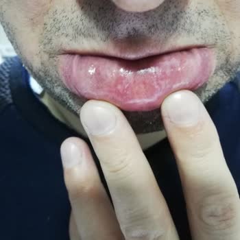 Sensodyne Diş Macunu Ağızda Yaralara Sebep Oldu