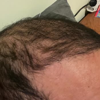 Medicool Saç Ekim Merkezi Mağduriyeti