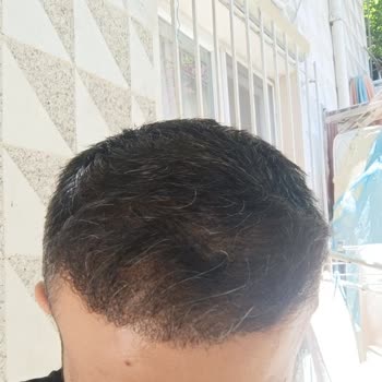 Saç Ekiminde Yüksek Adrenalin Ve Nekroz Mağduriyeti