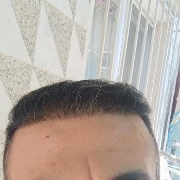 Saç Ekiminde Yüksek Adrenalin Ve Nekroz Mağduriyeti