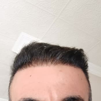 Saç Ekiminde Yüksek Adrenalin Ve Nekroz Mağduriyeti