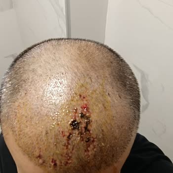 Saç Ekiminde Yüksek Adrenalin Ve Nekroz Mağduriyeti