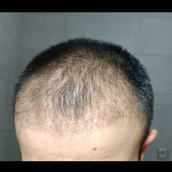 Saç Ekiminde Yüksek Adrenalin Ve Nekroz Mağduriyeti